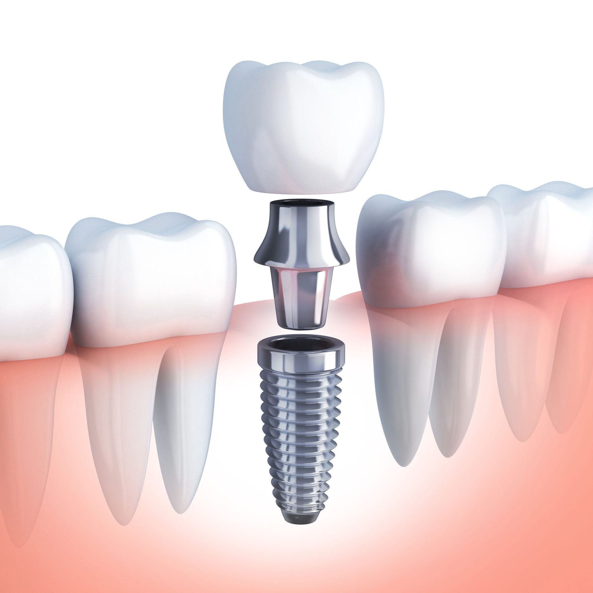 Cấy ghép Implant